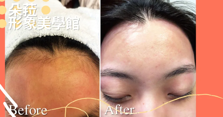 【台南美容/熱蠟除毛】台南朵菈形象美學館 / 台南熱蠟除毛推薦 / 髮際線、眉毛、上嘴脣汗毛除毛 / 台南南區除毛首選